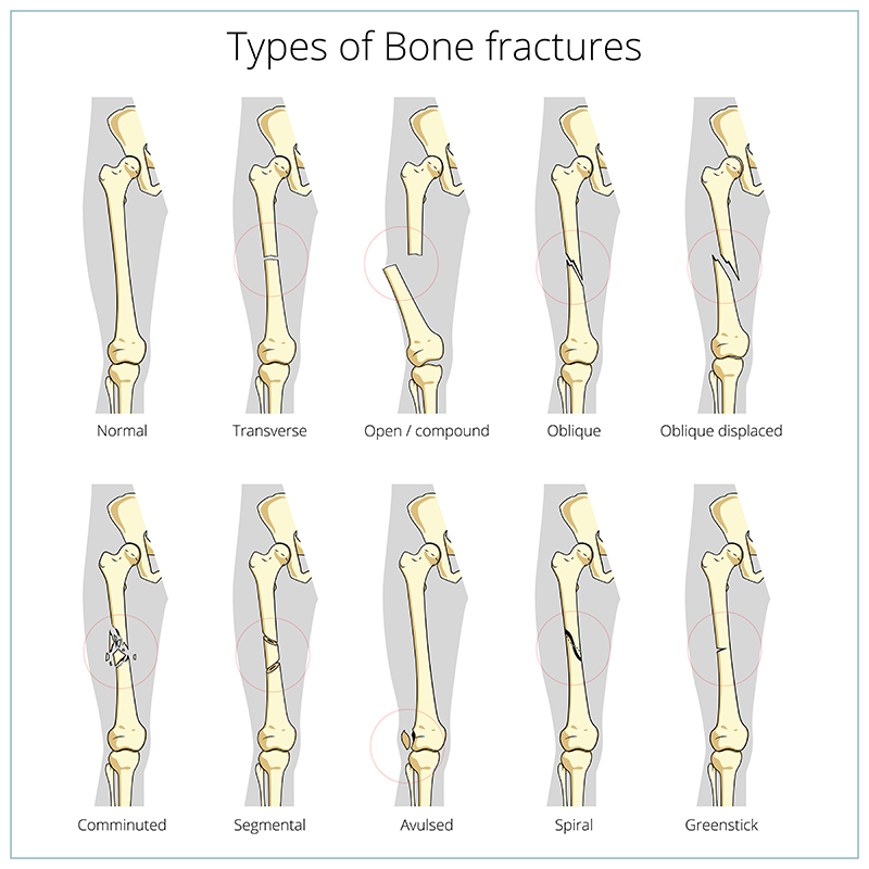 compound bone fracture