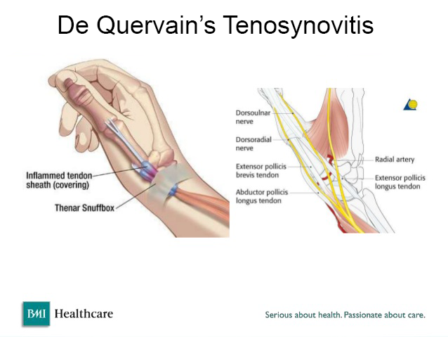 Cubital Tunnel Syndrome  FORM Hand, Wrist & Elbow Institute