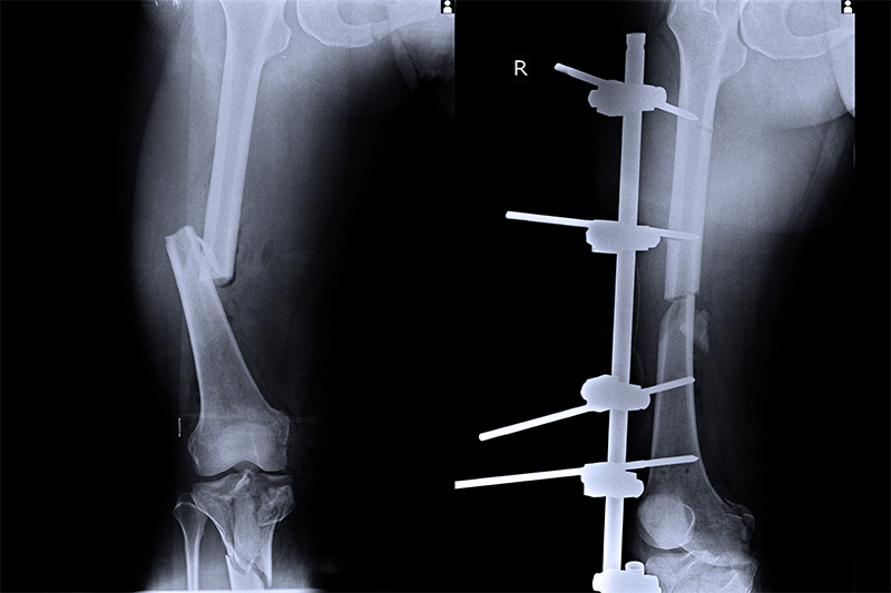 Fractures Broken Bone Fremont Orthopedic Rehabilitation Medicine