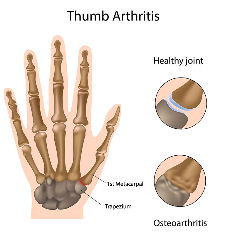 What causes arthritis in fingers and who is the most at risk?