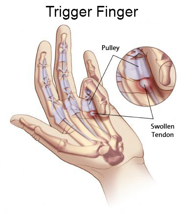 Finger trigger Trigger Finger