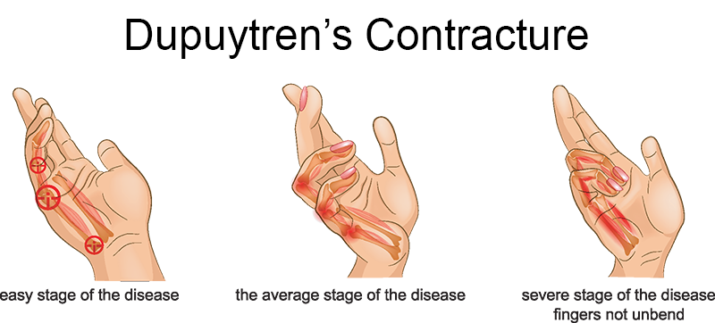 Dupuytren's Contracture  Fremont Orthopedic & Rehabilitation Medicine