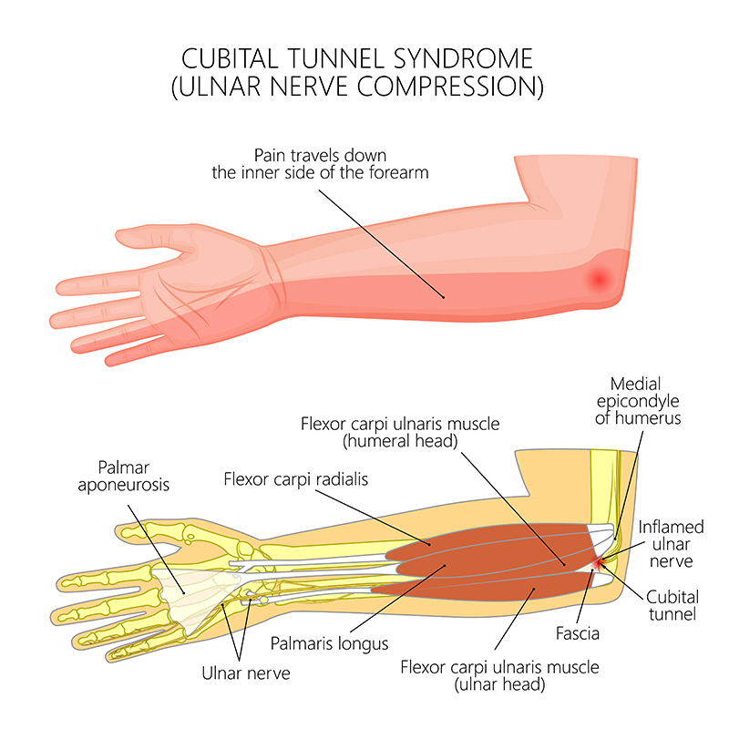 Wrist and forearm deals pain